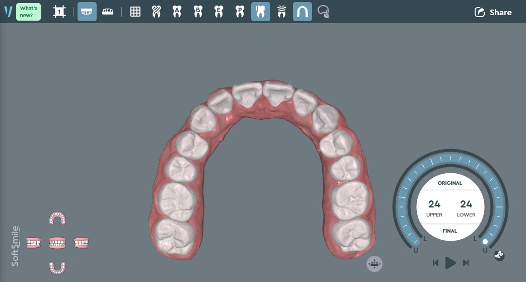 上顎イメージ画像